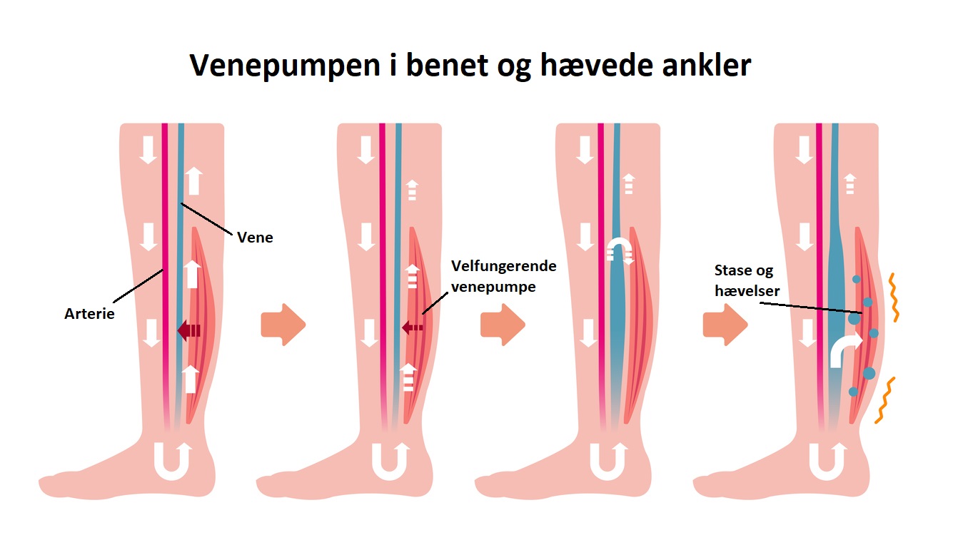 Venepumpen og hævede ankler