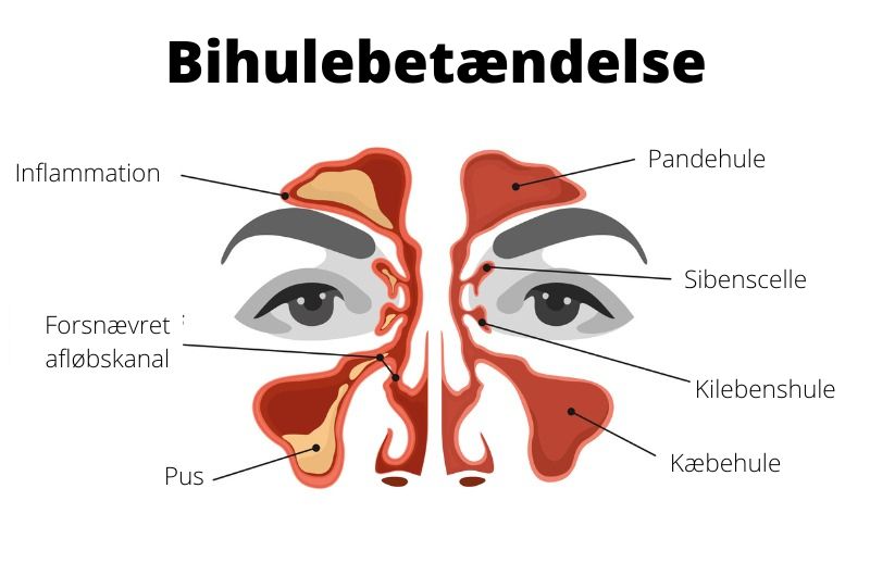 Bihulebetændelse