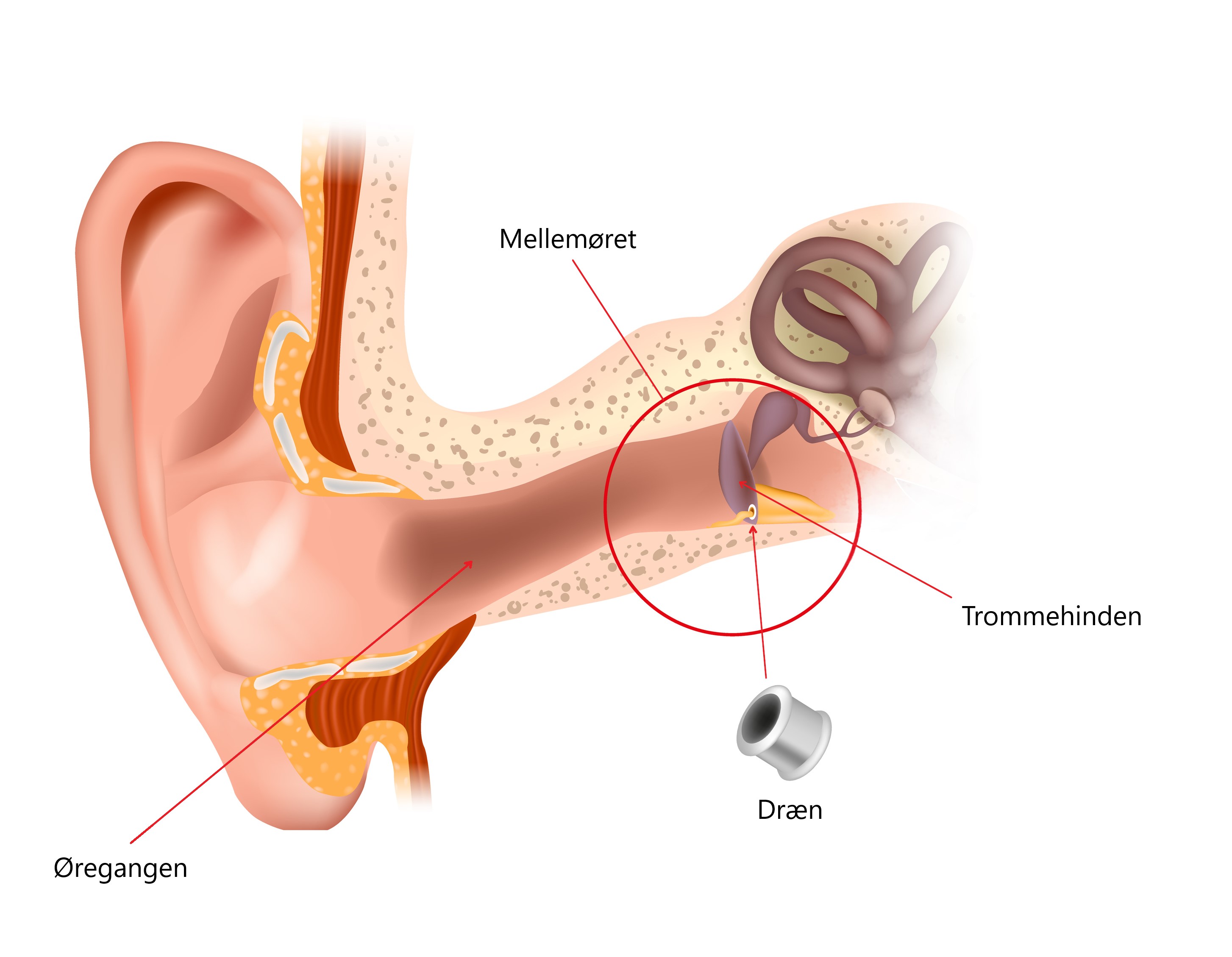 Dræn i øret Dræn i øret