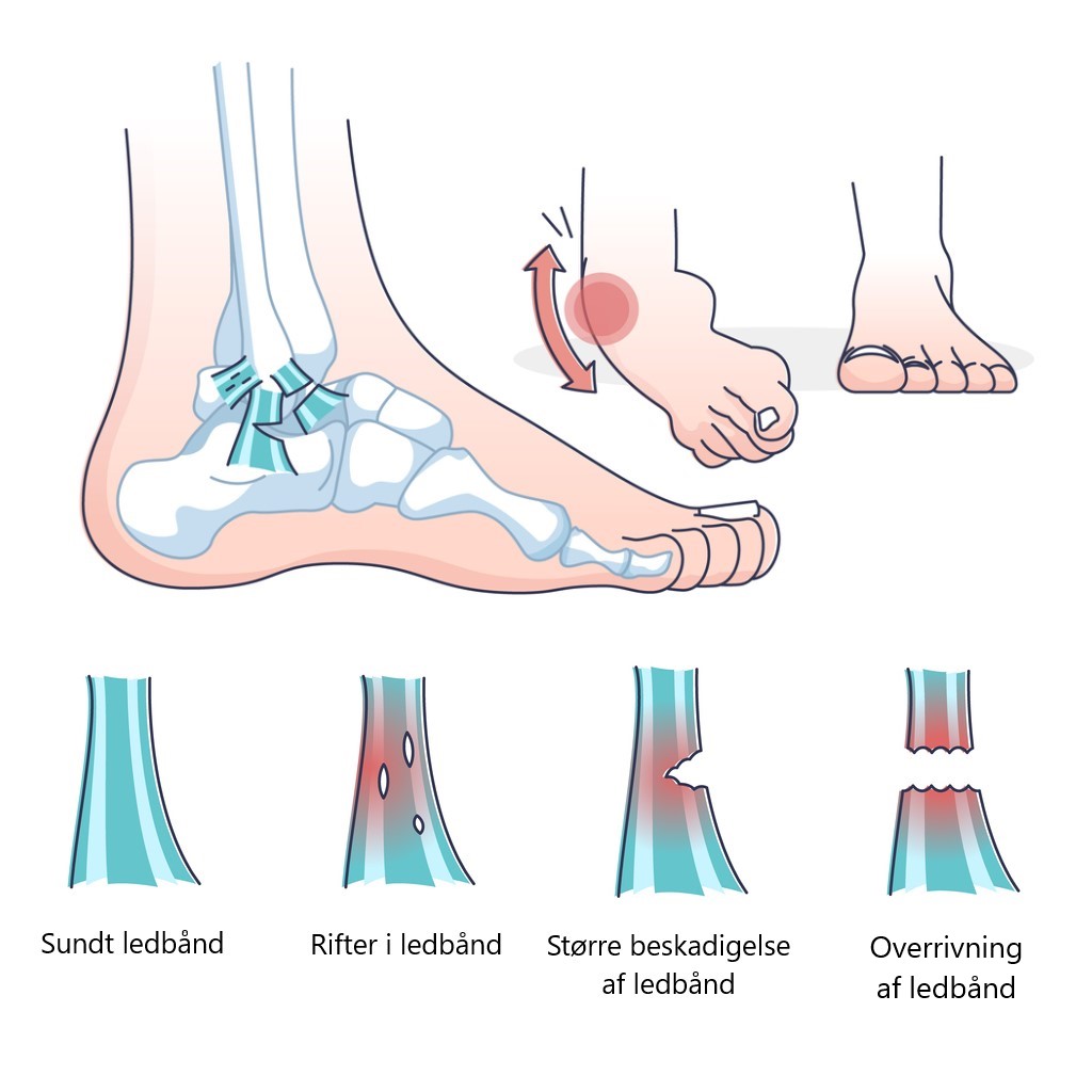 Bruskskader kan b&aring;de opst&aring; pludseligt og gradvist
