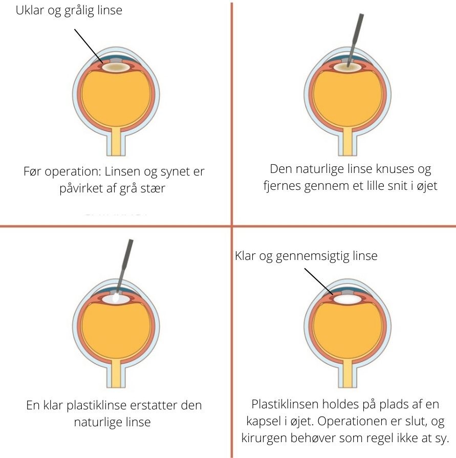 Operation for gr&aring; st&aelig;r