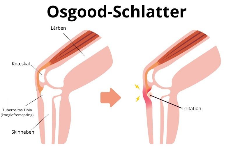 Osgood-Schlatter. Billede: IStock.com