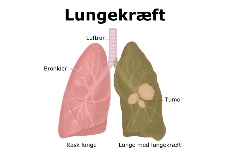 Rask lunge og lunge med kr&aelig;ft. Foto: IStock.com