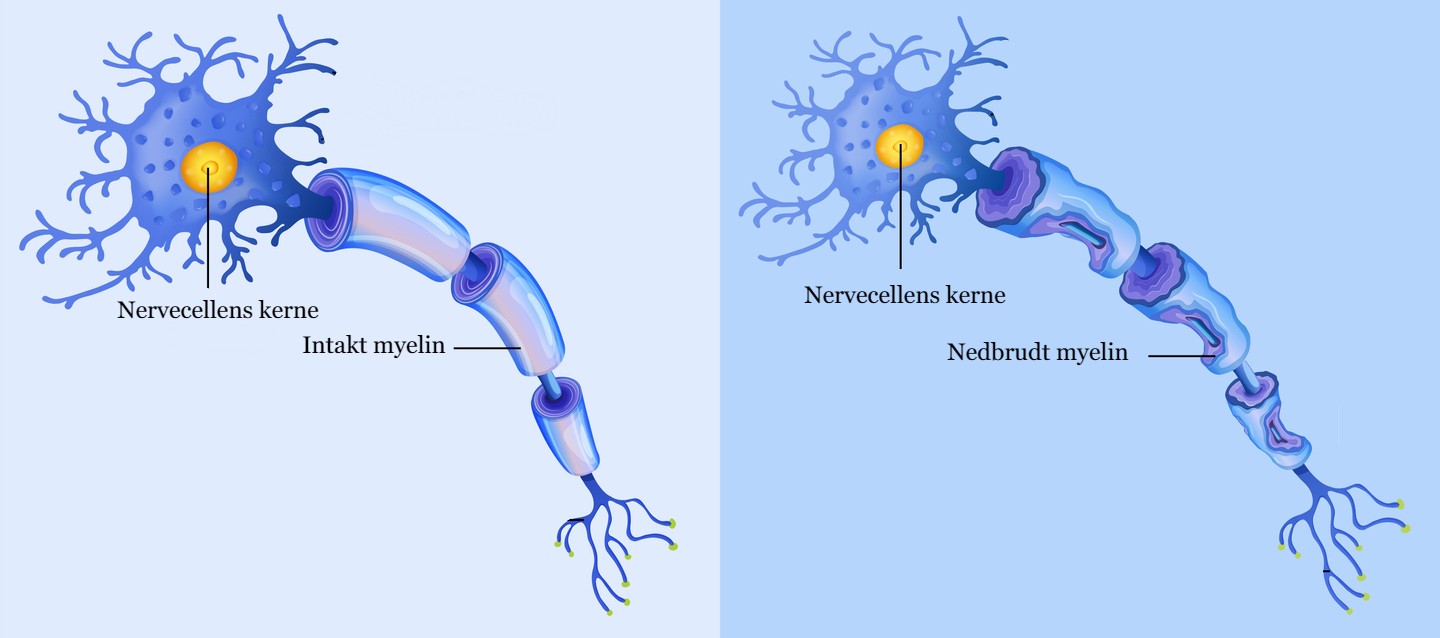 Nervecelle med sclerose, hvor myelinet er &oslash;delagt